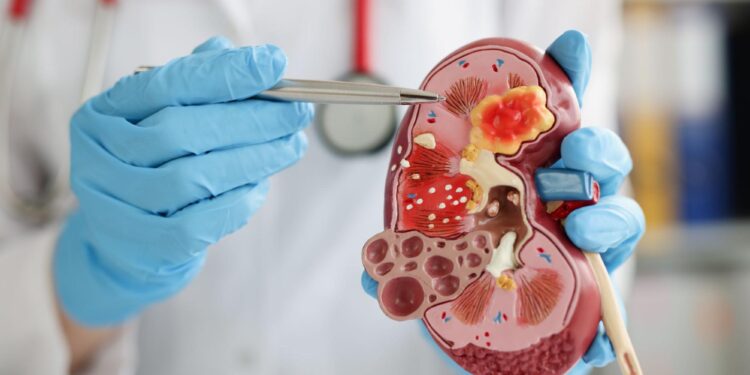 ನೀರಿನಂಶದ ಕೊರತೆಯಿಂದಾಗಿ ಸುಡು ಬಿಸಿಲಿಗೆ ಕಿಡ್ನಿ ಸ್ಟೋನ್ ಹೆಚ್ಚಳ ಸಾಧ್ಯತೆ