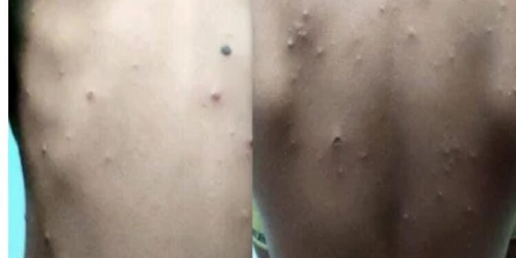 ಉರಿ ಬಿಸಿಲು ಸಾಂಕ್ರಾಮಿಕ ಸಿಡುಬು ಅಥವಾ ಚಿಕನ್‌ಪಾಕ್ಸ್‌ ಹರಡುವ ಕಾಲ